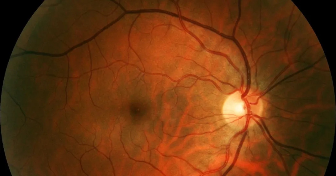 Retinal image