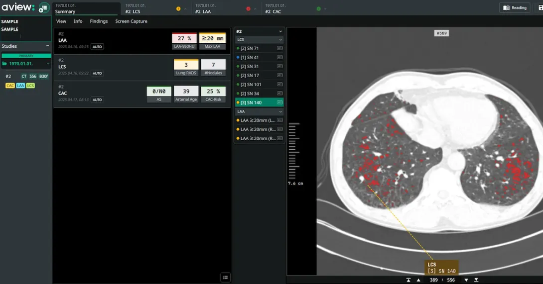 Interface of Coreline Soft's AI-powered chest X-ray analysis software